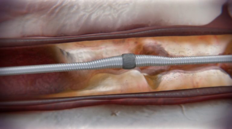 New Technique Opens Blocked Coronary Arteries   Diamondback 768x430 